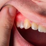 Natural Antibiotics for Tooth Infection