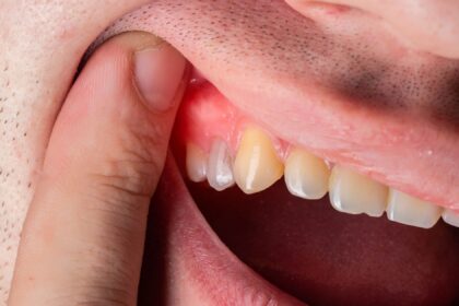 Natural Antibiotics for Tooth Infection