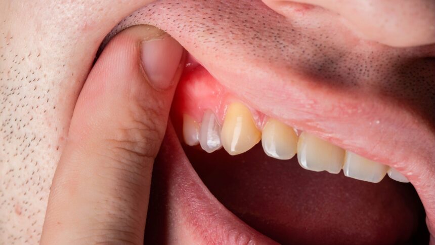 Natural Antibiotics for Tooth Infection