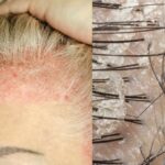 Scalp Psoriasis at Home