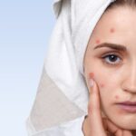 What Herbs Are Good for Skin Inflammation