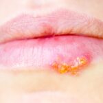 natural-remedies-for-herpes