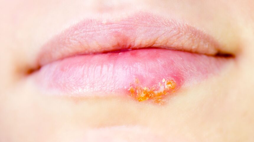 natural-remedies-for-herpes