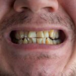 Does Turmeric Stain Your Teeth