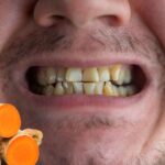 Does Turmeric Stain the Teeth?