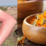 Is Calendula Good for Sunburn