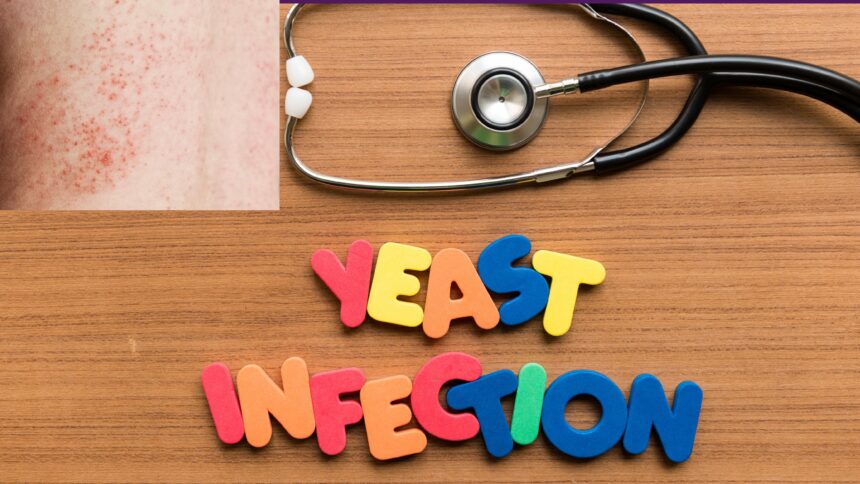 Natural Remedies for Yeast Infection on Skin